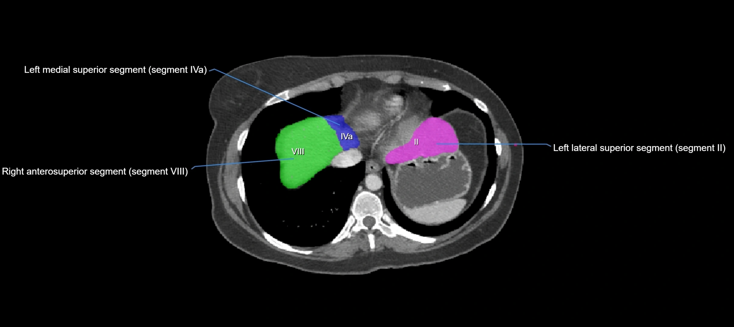CT liver segments axial cross sectional anatomy labelled image-00072.webp
